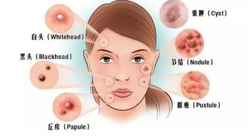 想要根治痘痘 先来了解一下诱发痘痘的根源吧