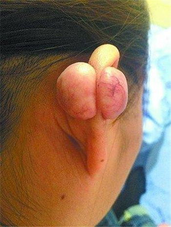 女子耳朵长出大疙瘩 竟是疤痕疙瘩
