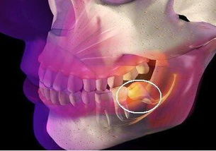 重庆智齿不拔有哪些危害呢 