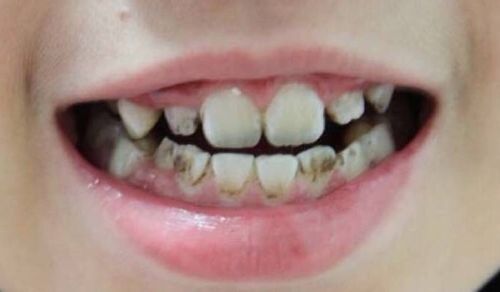 牙齿上出现这种 小黑点 ,你要注意了,基本能毁掉整颗牙