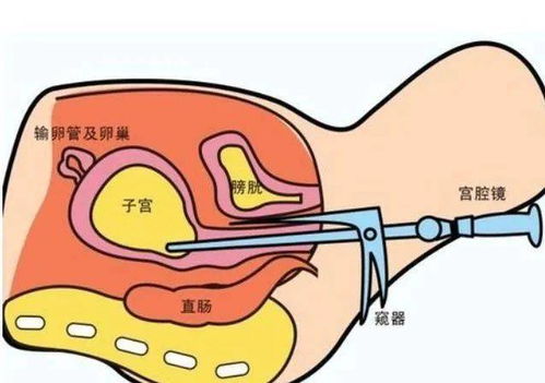 宫腔镜检查对身体有伤害吗