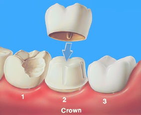 1.镶牙是这么固定在牙齿上的,用什么固定,拔掉的牙这么固定,2.拔牙后多久镶牙最好,3.零时牙和要 