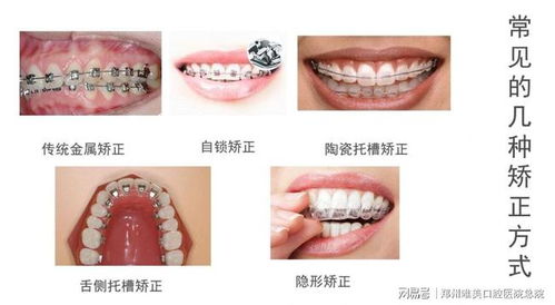 牙齿矫正有哪几种方法