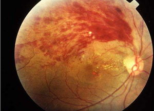 视网膜脱落了,手术之后还能恢复到以前的状态吗 