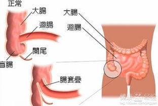 肠套叠疼痛会持续多久