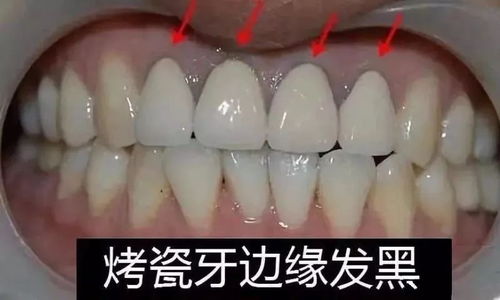 医生是不建议做烤瓷牙吗