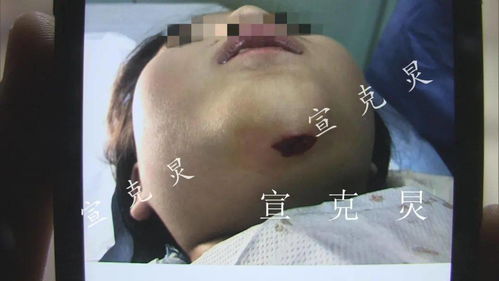 这个动作千万别做 上海9岁女孩泳池破相,伤口深可见骨