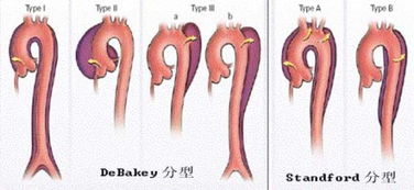 主动脉夹层的疾病随访 