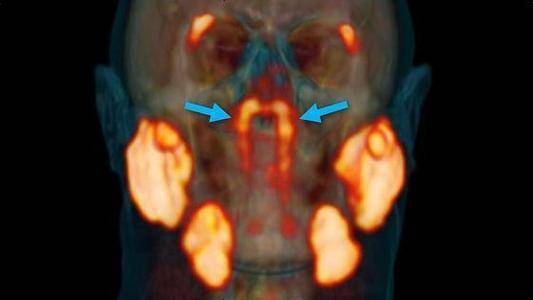 科学家在人体内发现未知新器官,或对治疗癌症有所帮助