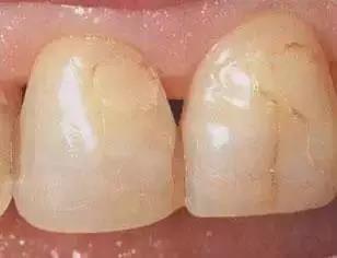 牙齿裂开最好的治疗方法(牙齿裂开是什么症状)