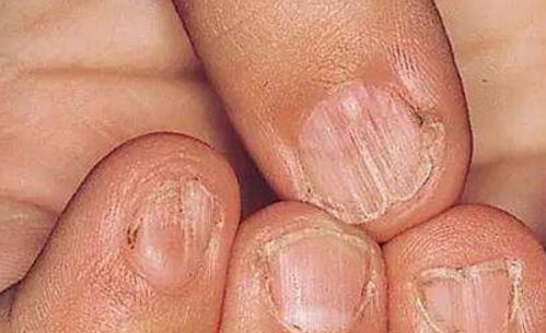 经常咬手指甲的人,可能是身体的3个本能反应,多数人或许忽略