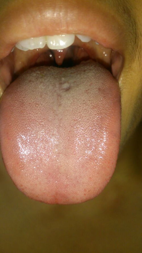 舌苔发白怎么治疗