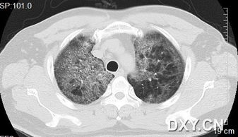 双肺弥漫性病变 已取病理