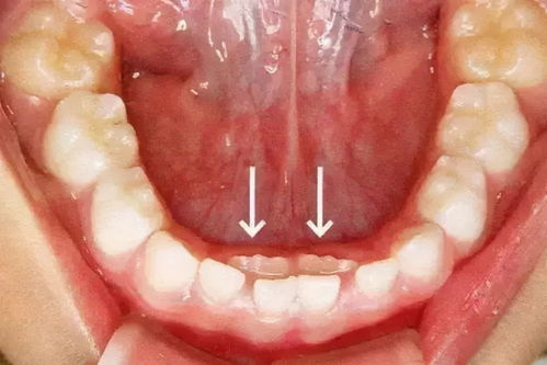 孩子乳牙没掉,新牙就已长出 造成孩子乳牙脱落晚的原因不止一种