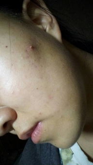 右脸上老长痘痘,我经常用手挤留下好多凹痘疤,而且痘痘也长的越来越 