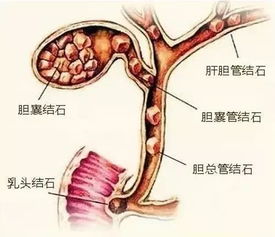 胆囊切除,有啥后遗症 医生坦言 确实有4种,非万不得已,别切 胆汁 