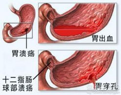 胃出血需要做手术吗