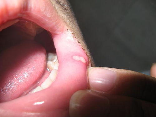 蝼齿会经常口腔溃疡咽喉发炎,戴牙套快两年了,收缝隙的牙龈肿痛,牙齿非常痛,是什么原因?