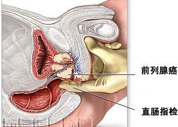 前列腺大小为4.8x2.2x2.4 前列腺形态包膜完整 回声欠均匀 内外腺比例正常 其内未见明显异常回声