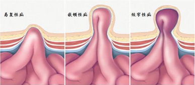 啥是小儿疝气 怎么治疗