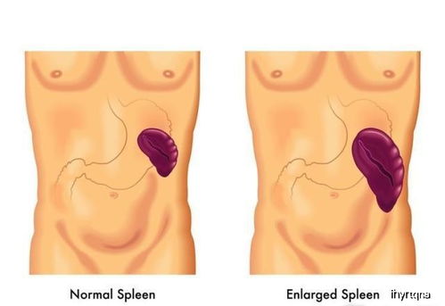 肝 硬 了,脾就会变 大 肝硬化脾大,隐蔽却危险