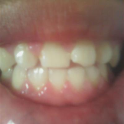 牙龈炎和牙周炎吃什么药