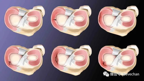 半月板撕裂别流泪,眼泪擦干看这里
