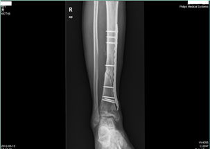 右胫骨下段骨折内固定术后半年,发现右小腿肿物 相邻腓骨骨质破坏