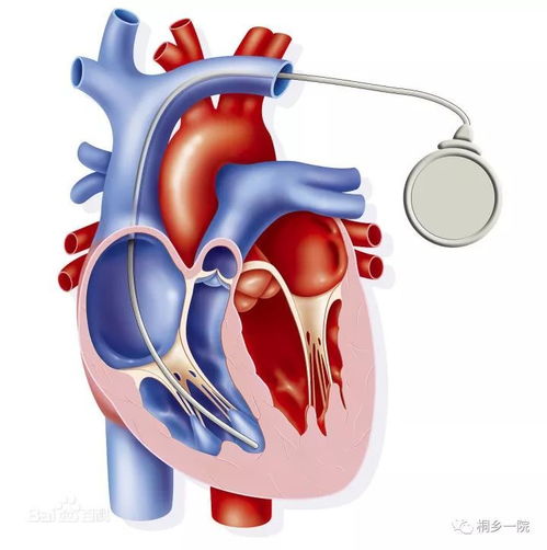 心脏起搏器健康险 健康险公司 
