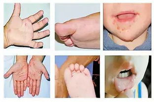 手足口病有什么症状？手足口病有哪些症状