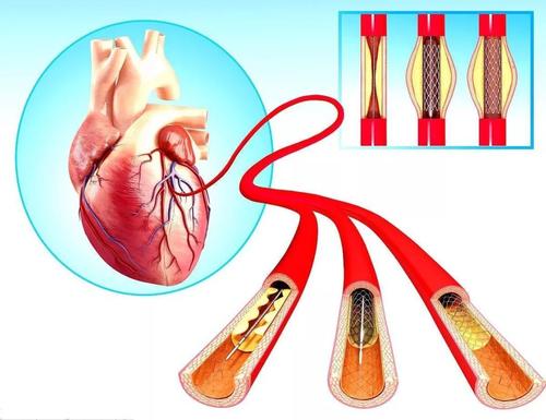 心脏支架手术百万医疗保险报销吗 心脏支架职工医保报销多少 