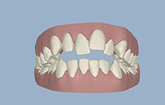 矫正牙齿的好处是什么 