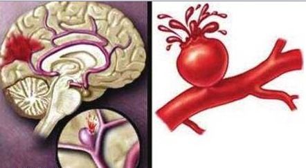 脑血管痉挛吃什么药