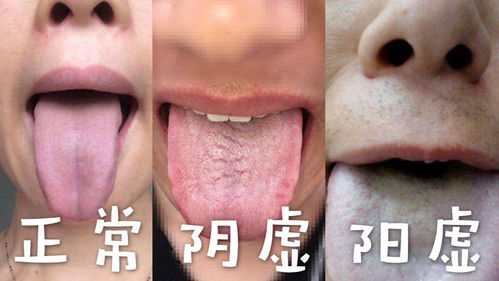 肾虚的舌象图片图片