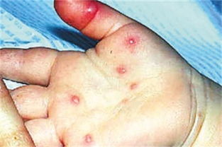 手足口病症状？手足口病的症状是什么