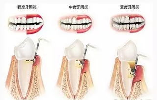 一生中必拔的七颗牙 快来看看你有几颗 