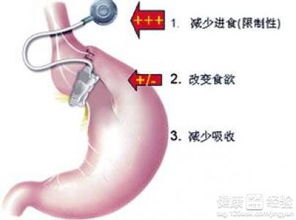 肥胖症的预防方法有什么