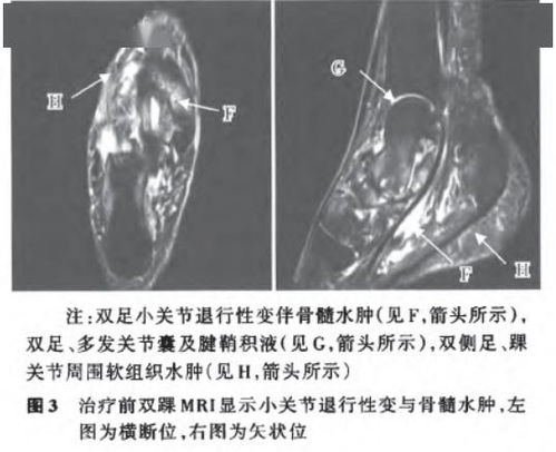 红外热成像检查胃道炎炎症