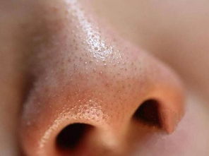 鼻子长黑头的原因 黑头是什么？为什么鼻子上的黑头一直去除不干净？ 