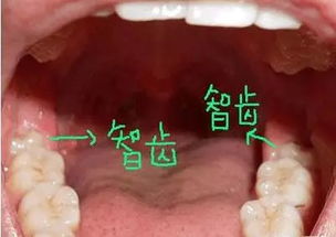 智齿烂了个大窟窿,可以拔掉吗