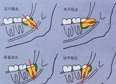 不痛不要紧 痛起来真要命 贵阳每个孩子都会遇到这个问题