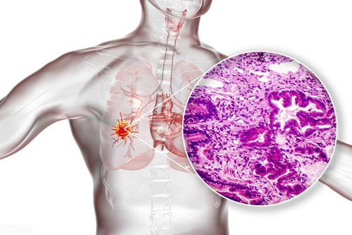 生而不同,肺鳞癌和肺腺癌的差异有哪些