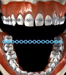 超详细的牙齿矫正过程