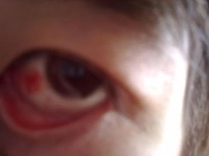 眼睛里面有血块 是什么病阿 严重么 