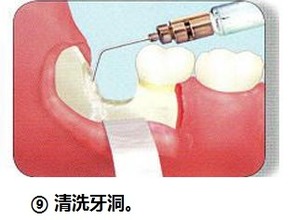 拔智齿全程图解,我就问你怕不怕 