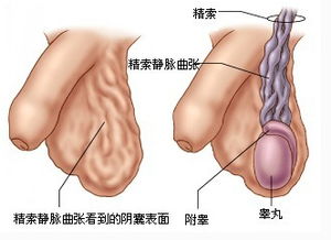 精索静脉曲张必须手术吗