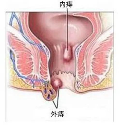 冬季肛肠病高发,是 攒着 还是 治疗