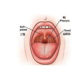 喉炎，咽炎和喉炎的区别