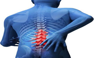 腰椎疼痛不一定是腰病 警惕多发性骨髓瘤的发生