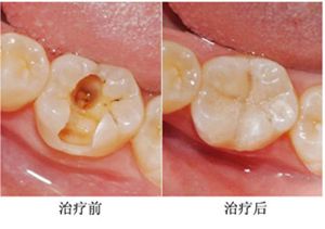 我有蛀牙,还补过了牙齿,能不能再洗牙